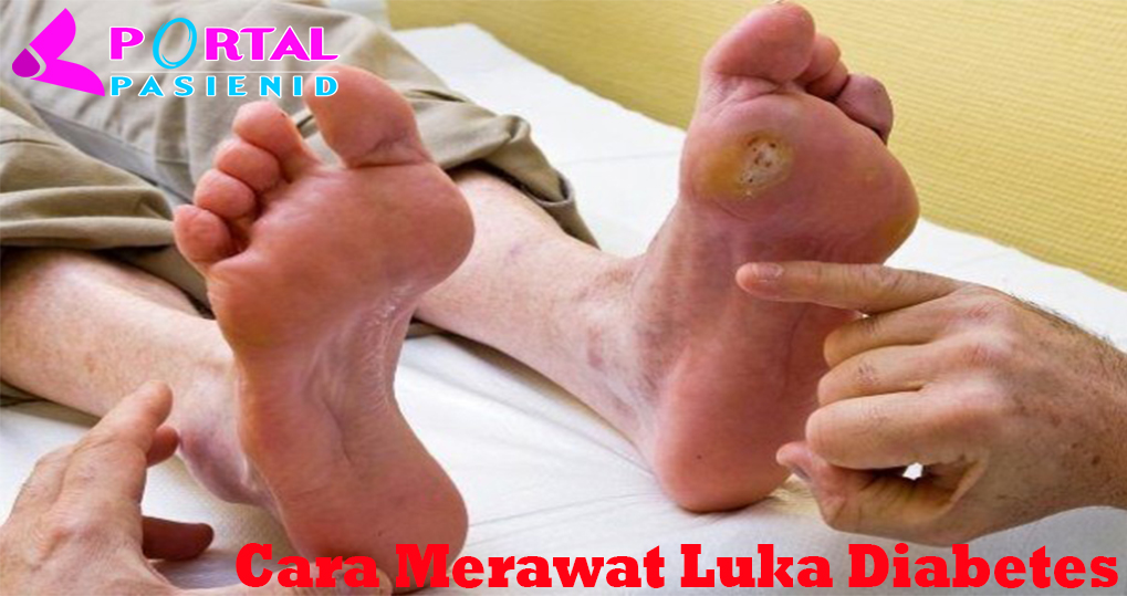 Cara Merawat Luka Diabetes