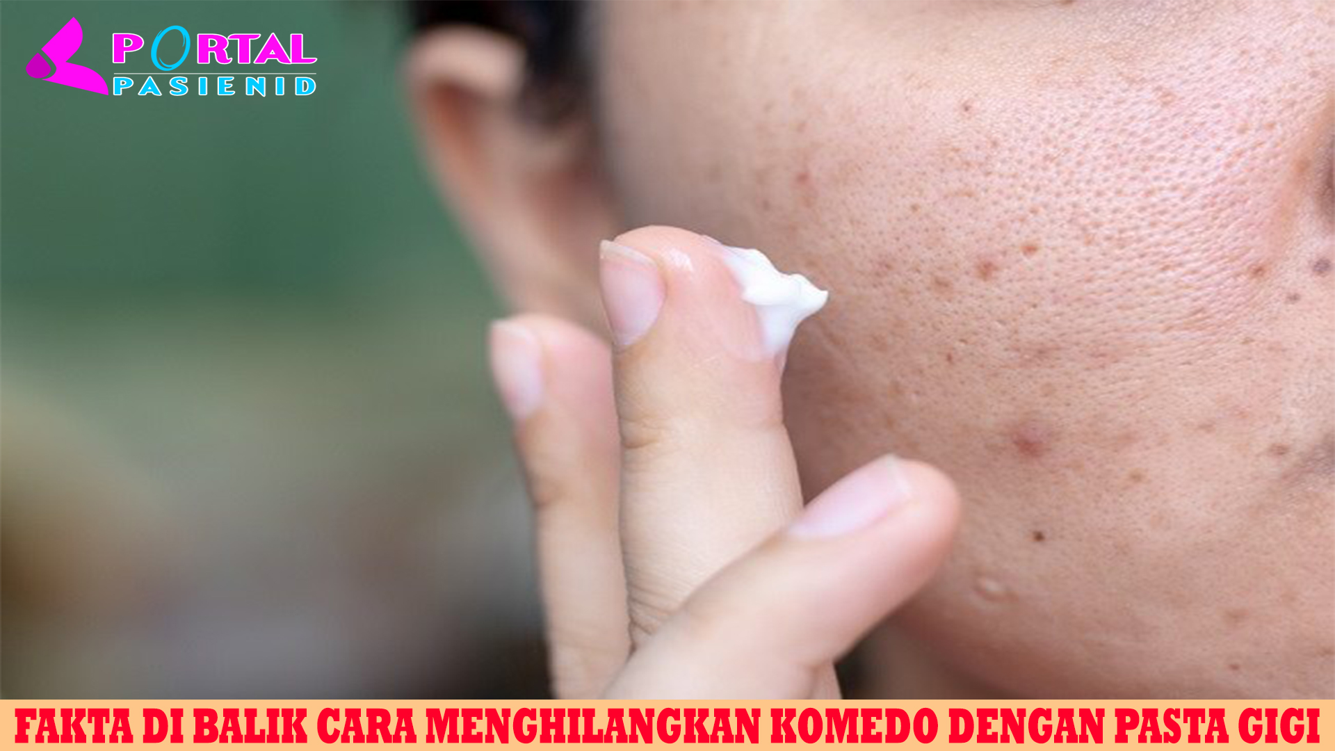 Fakta di Balik Cara Menghilangkan Komedo dengan Pasta Gigi