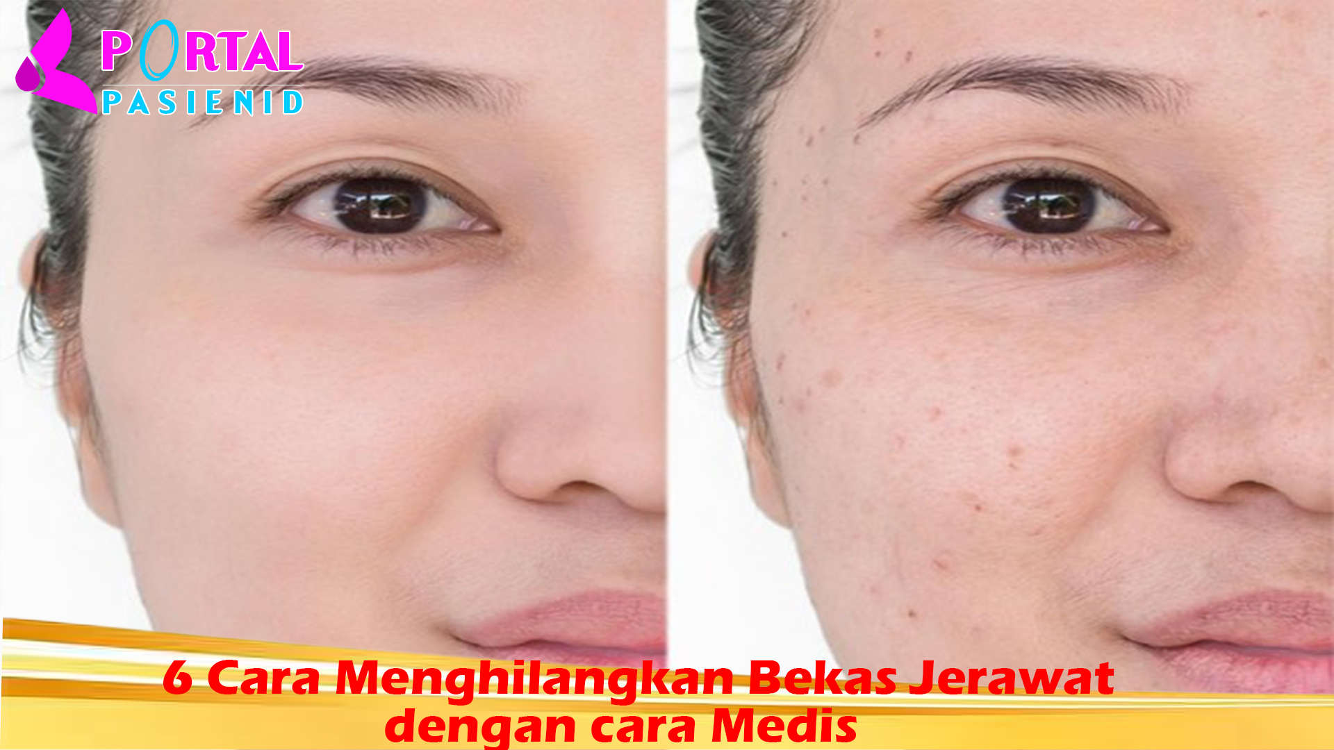 6 Cara Menghilangkan Bekas Jerawat dengan cara Medis