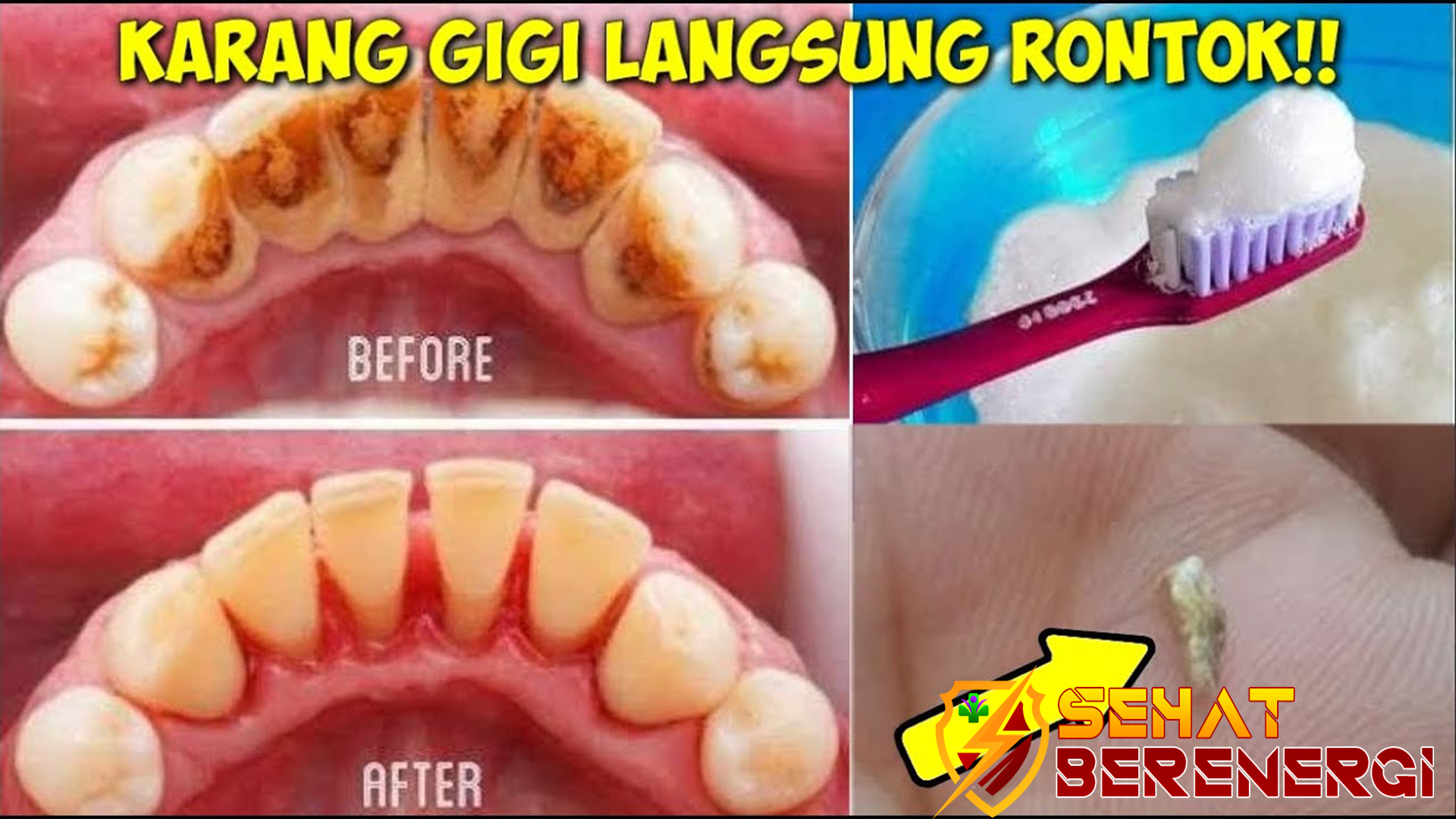 Simak Langkah Membersihkan Karang Gigi Secara Alami di Sini!