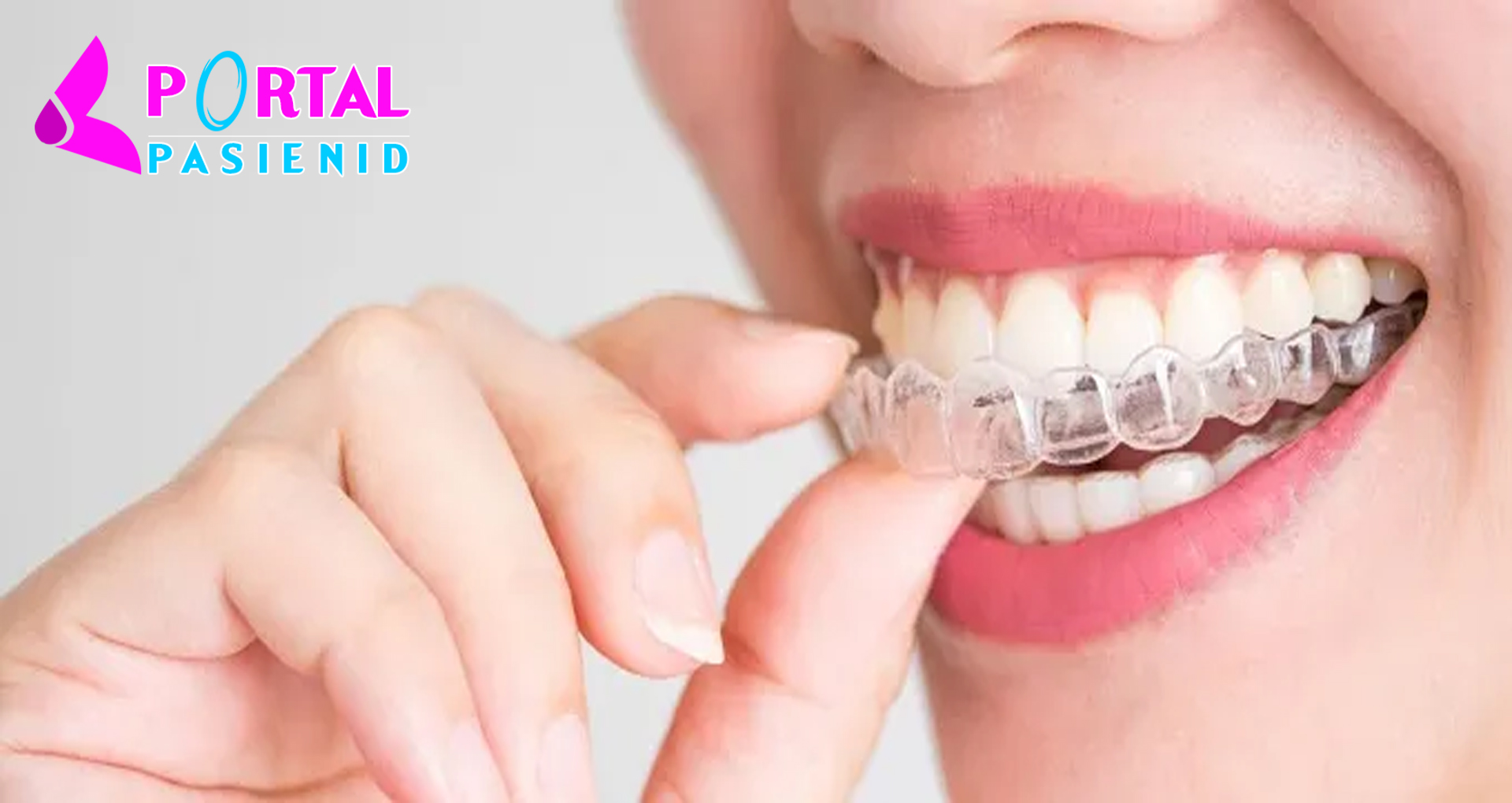 Behel Transparan, Cara Merapikan Gigi Tanpa Kawat